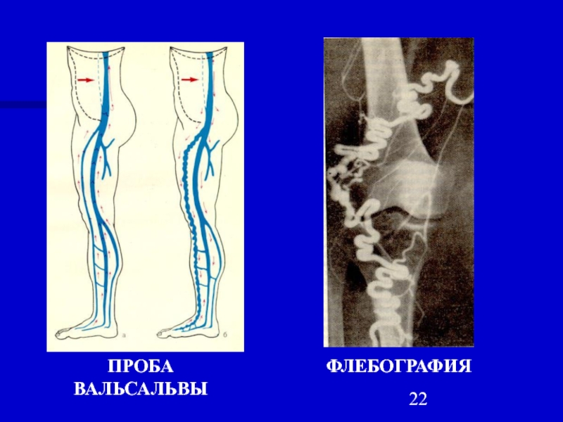 Варикозное Расширение Вен Мрт