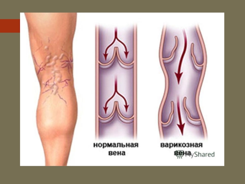 Варикоз Вен У Беременных