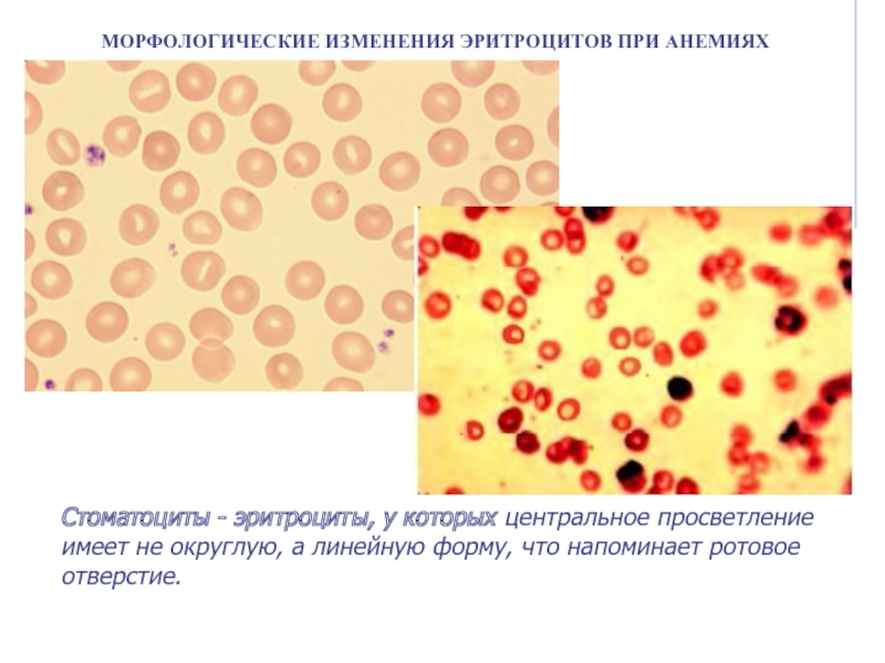 Морфологические изменения в эритроцитах рисунок