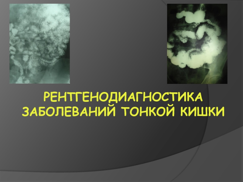 Презентация Рентгенодиагностика заболеваний тонкой кишки