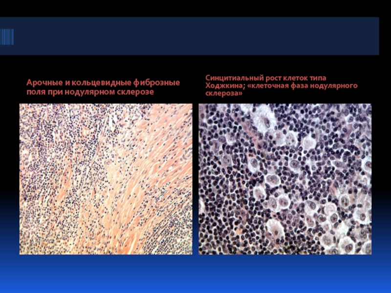 Арочные и кольцевидные фиброзные поля при нодулярном склерозеСинцитиальный рост клеток типа Ходжкина; «клеточная фаза нодулярного склероза»
