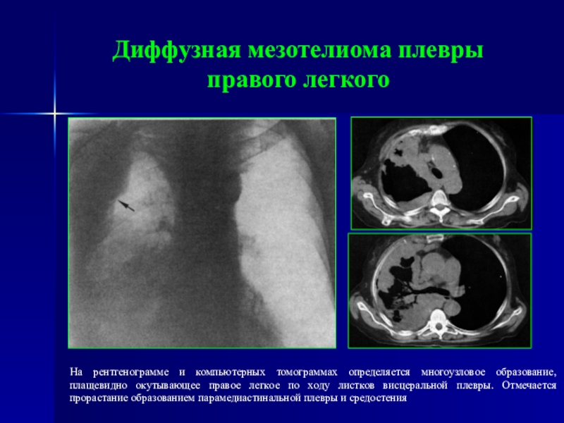 Мезотелиома плевры кт картина