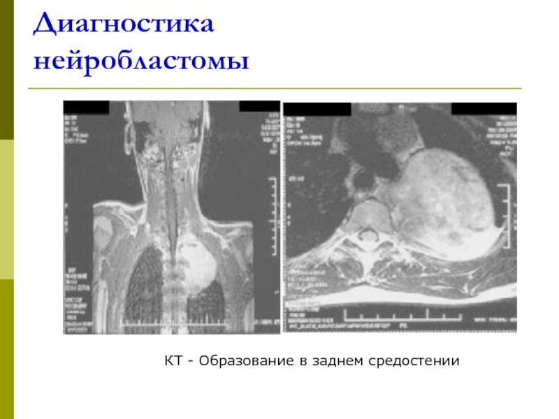 Нейробластома у детей презентация