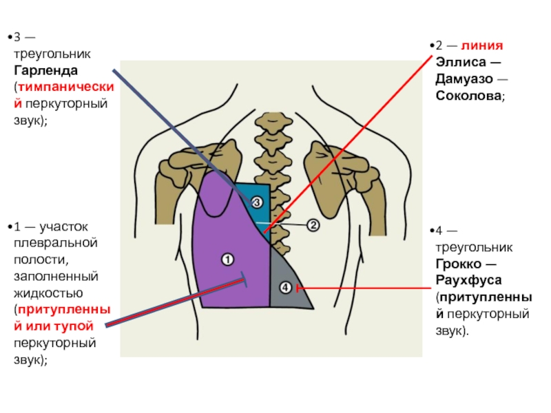 Перкуторная картина у больных с экссудативным плевритом