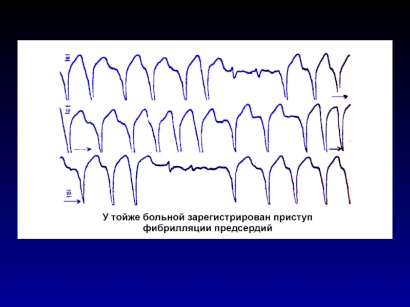 Параксизмфибриляций предсердий карта вызова смп