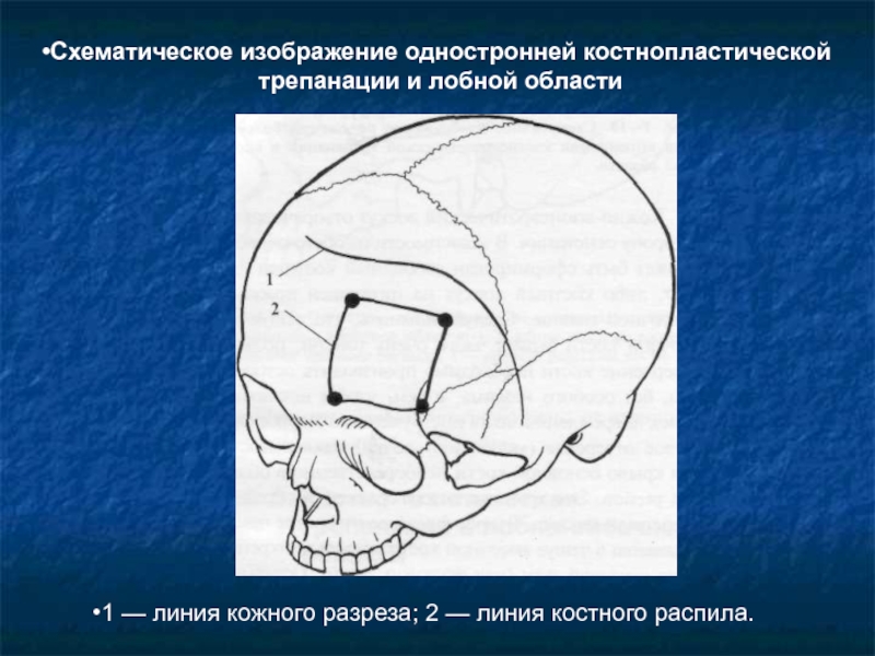 Костно пластическая трепанация черепа презентация