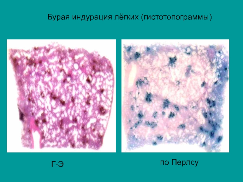 Бурая индурация легких микропрепарат рисунок