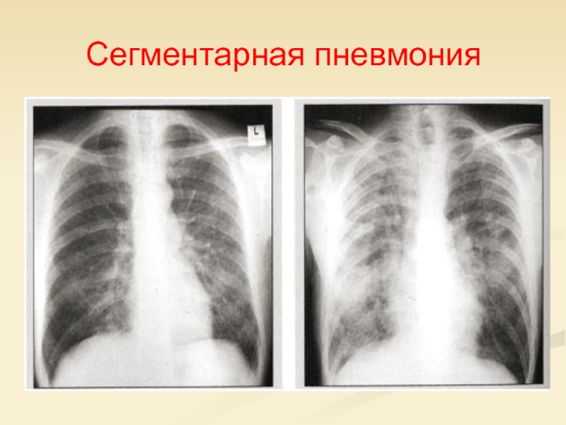 Сегментарная пневмония. Правосторонняя полисегментарная пневмония рентген. Сегментарная пневмония у детей рентген. Очаговая сегментарная долевая пневмония. Крупозная сегментарная пневмония.