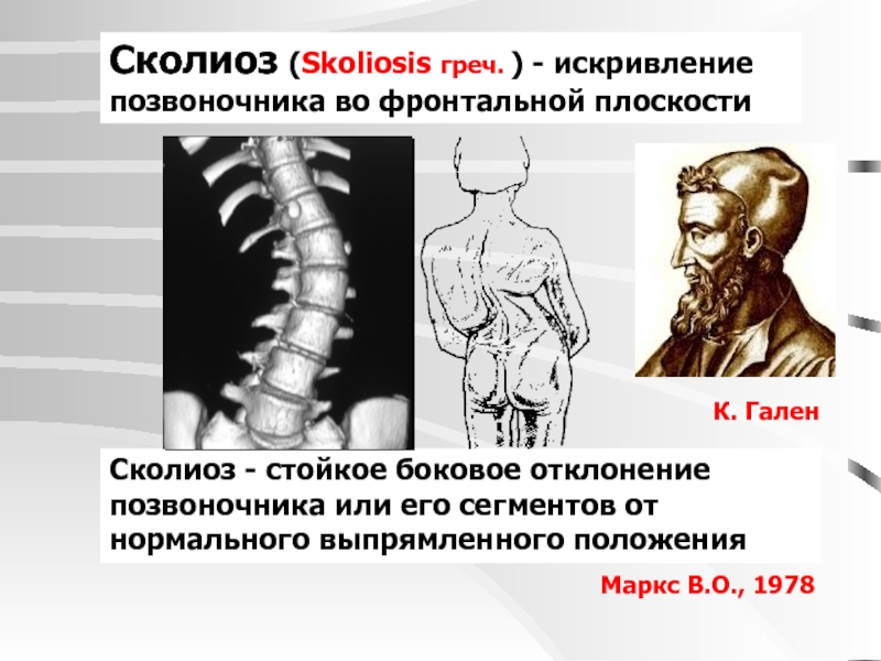 Сколиоз у детей картинки