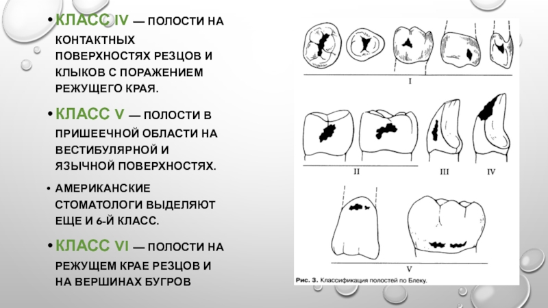 Кариозные полости 4 класса