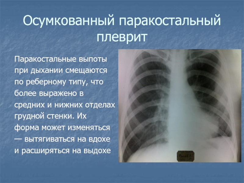 Экссудативный плеврит рентгенологическая картина