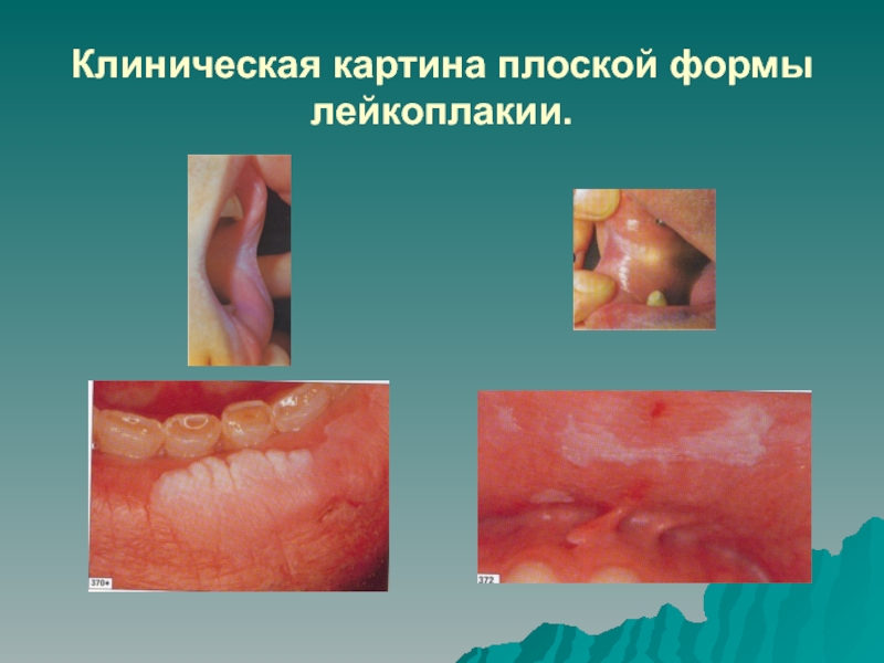 Лейкоплакия слизистой рта фото