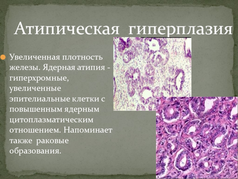 Клетки без признаков атипии. Железистая гиперплазия гистология. Атипичная гиперплазия протокового эпителия. Атипическая гиперплазия эндометрия. Атипическая гиперплазия эндометрия гистология.