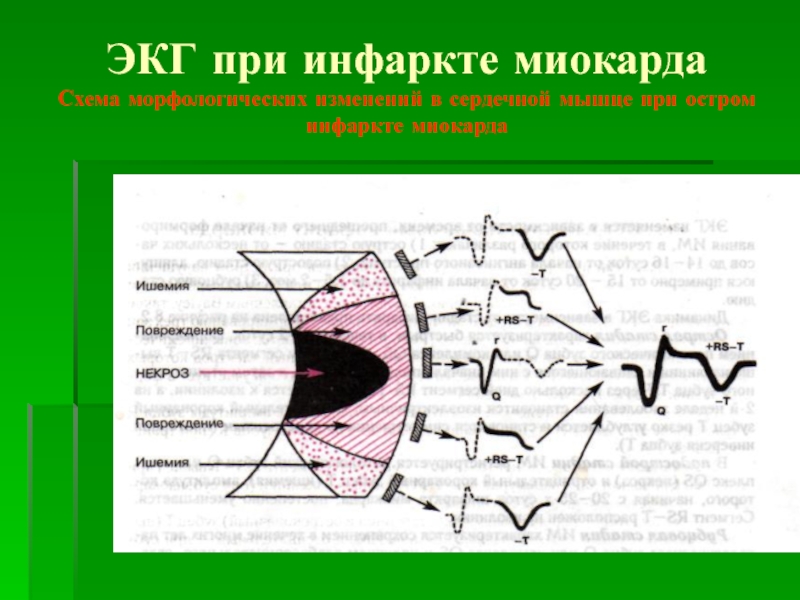 Презентация ЭКГ при инфаркте миокарда Схема морфологических изменений в сердечной мышце при