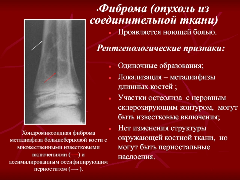 Фиброма кости. Посттравматический остеолиз. Опухоли из соединительной ткани. Метадиафиз.