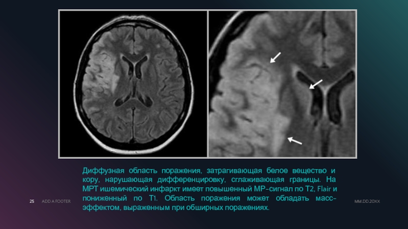 Ишемический инсульт головного мозга на мрт фото