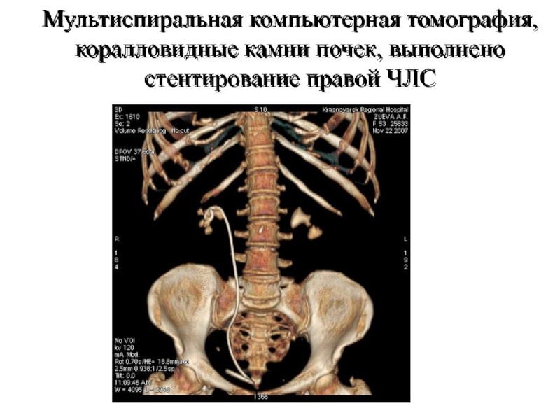 Кт почек презентация