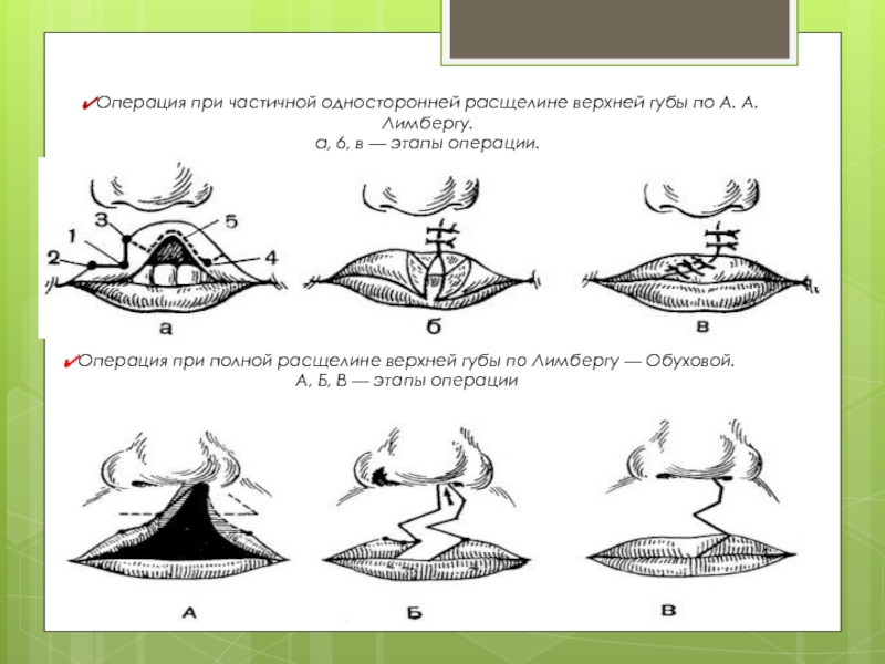 Виды расщелин губы и неба при ринолалии схема