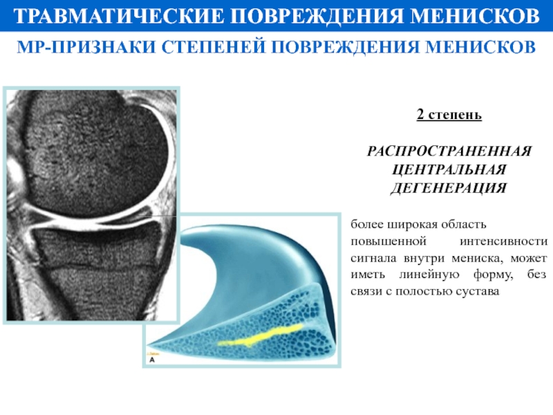 Разрыв мениска карта вызова