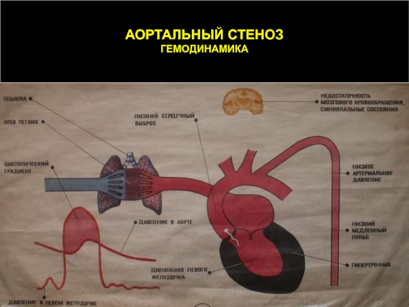 Схема гемодинамики при пороках сердца