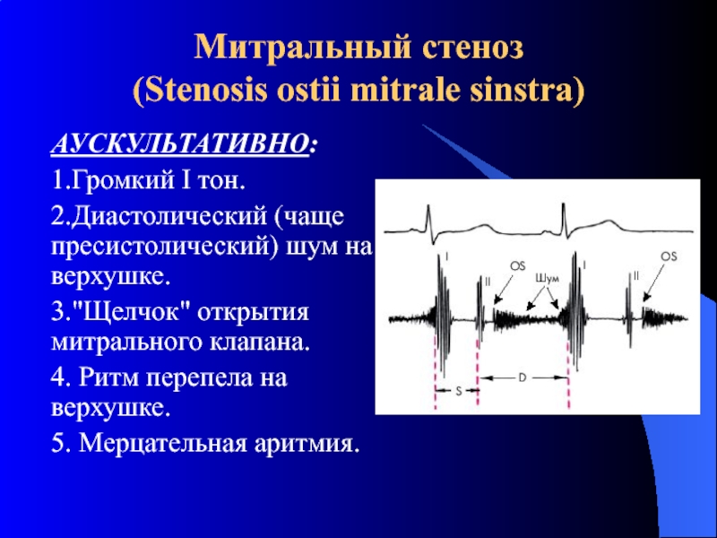 Аускультативная картина при митральном стенозе