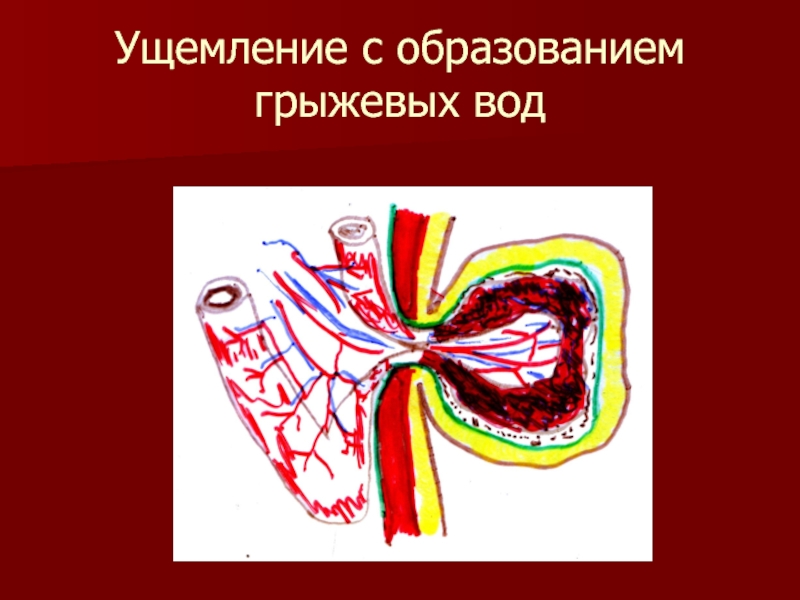 Осложнения грыж. Осложнения грыжи брюшной полости. Осложнения грыжи передней брюшной стенки. Осложнения наружных грыж живота. Образование грыжевых вод.