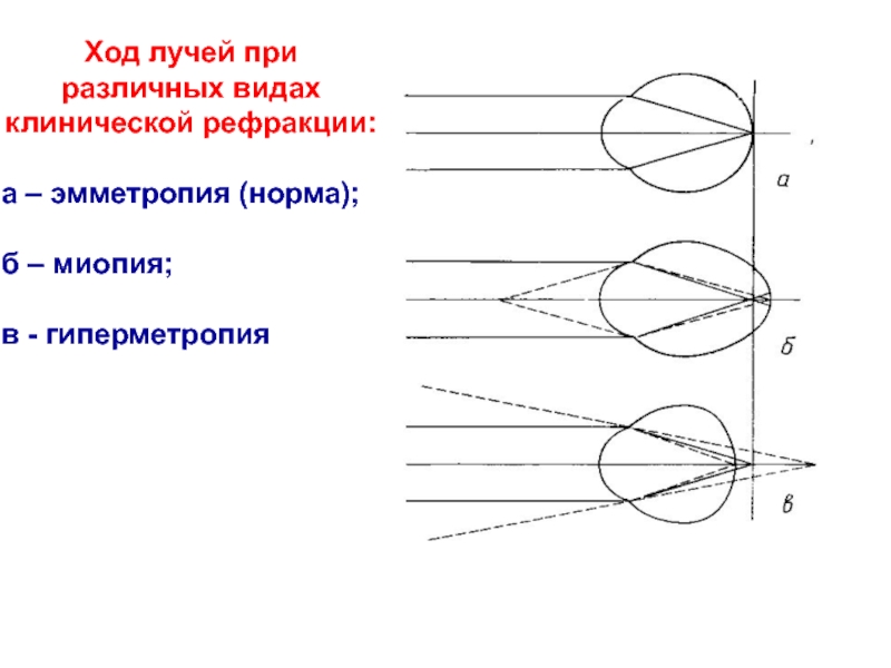 Рефракция эмметропия