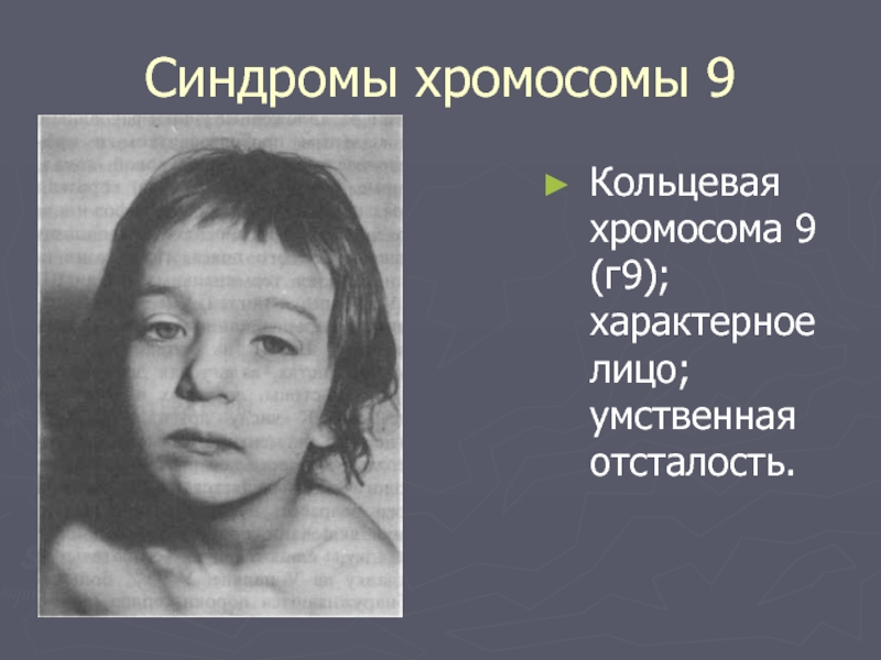 9 хромосома. Синдром умственной отсталости. Синдромы хромосомных болезней. Стигмы при умственной отсталости.