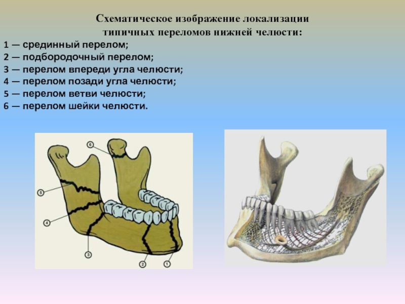 Перелом челюсти карта вызова