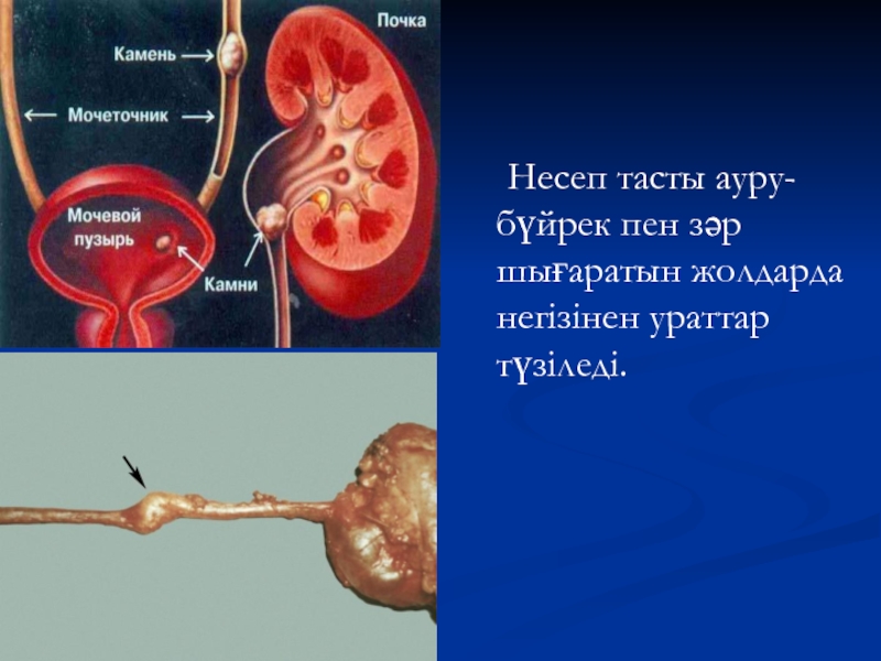 Презентация несеп тас ауруы