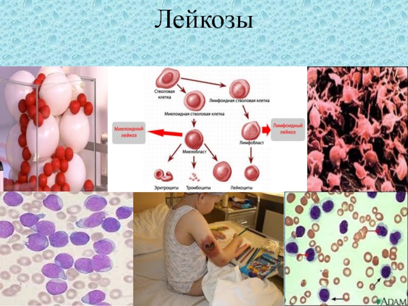 Бензольный лейкоз презентация