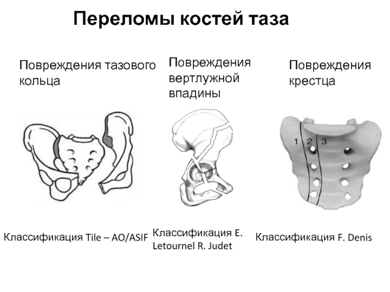 Закрытый перелом вертлужной впадины