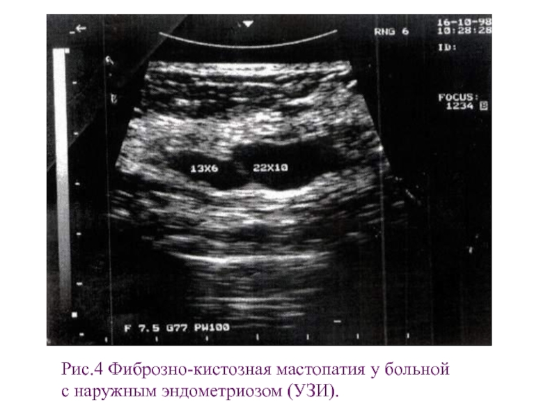 Фиброзно кистозная мастопатия на узи