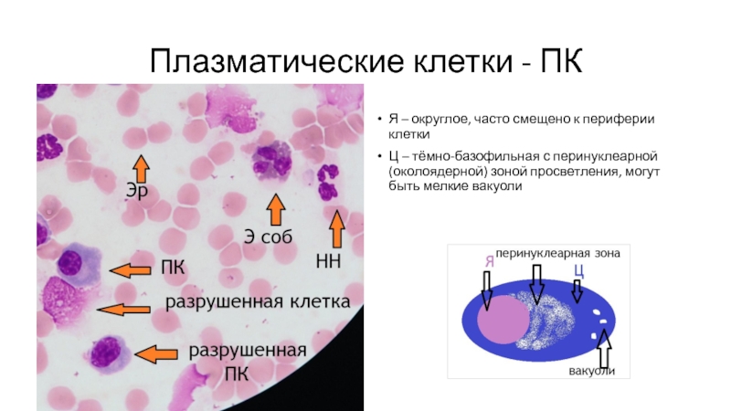 1 плазматическая клетка. Плазматические клетки. Плазматические клетки плазмоциты. Плазматические клетки в крови. Плазмоциты в периферической крови обнаруживаются при.