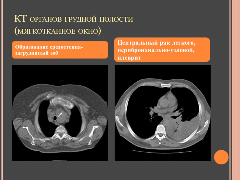 Мягкотканное образование в легком на кт. Легочное окно на кт. Мягкотканное окно на кт. Костное окно на кт. Образования средостения на кт.