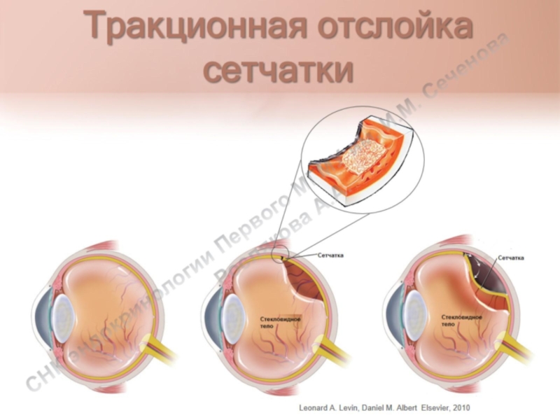 Тракционная отслойка сетчатки фото