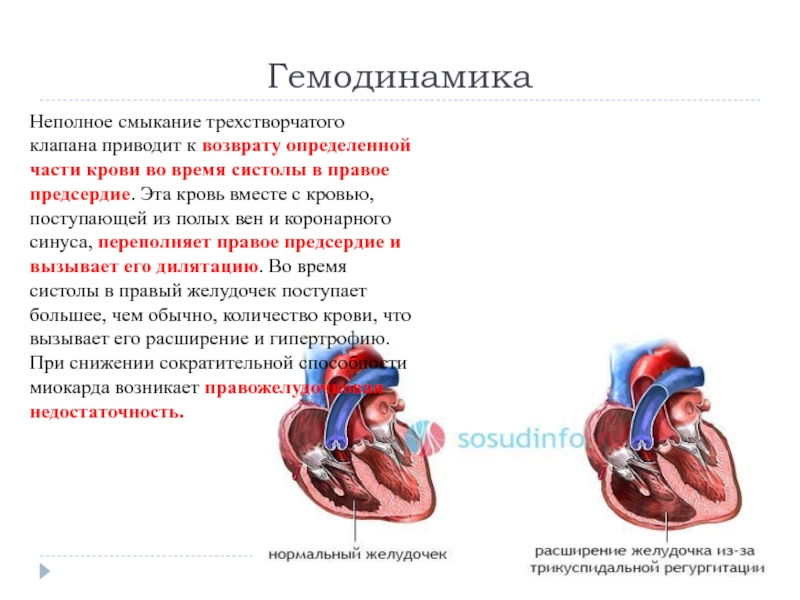 Недостаточность трехстворчатого клапана рисунок