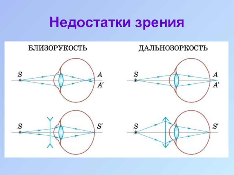 Какие дефекты зрения изображены на рисунках предложите дорисуйте способы их исправления