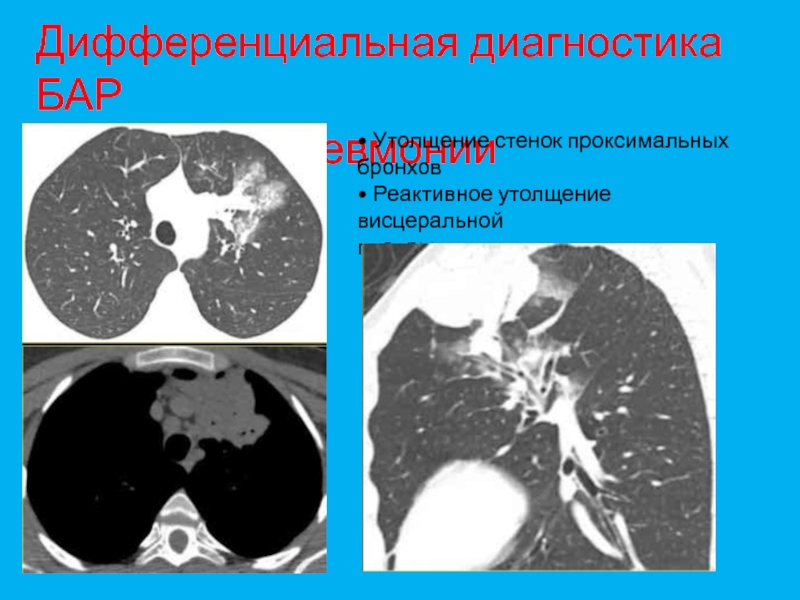 Утолщение стенок. Утолщение стенок бронхов на кт. Утолщение бронхов на кт. Утолщение стенок бронхов. Утолщенные стенки бронхов кт.