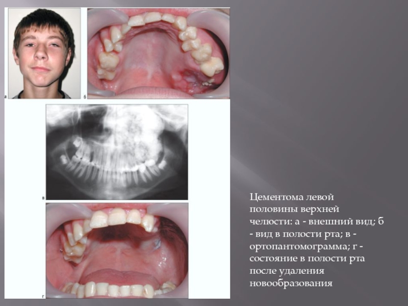 Цементома левой половины верхней челюсти: а - внешний вид; б - вид в полости рта; в -