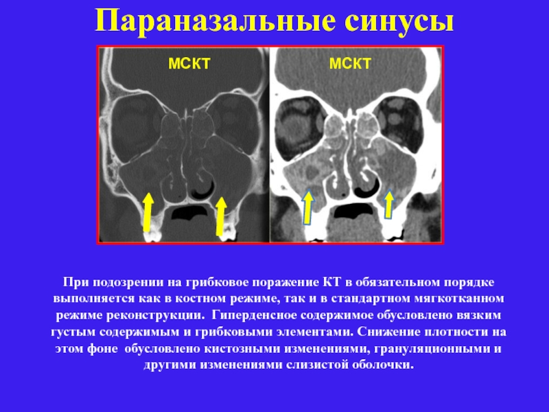 Гиперденсные структуры на кт изображениях