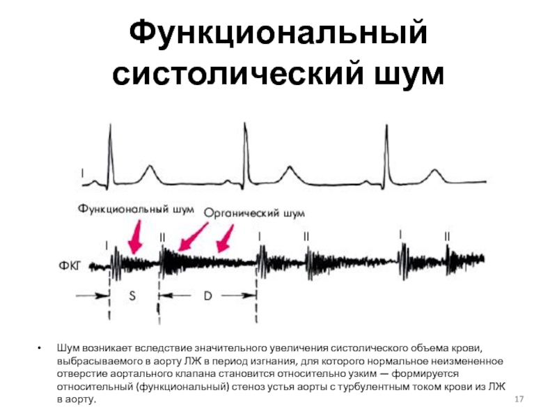 Аускультативная картина при митральном стенозе