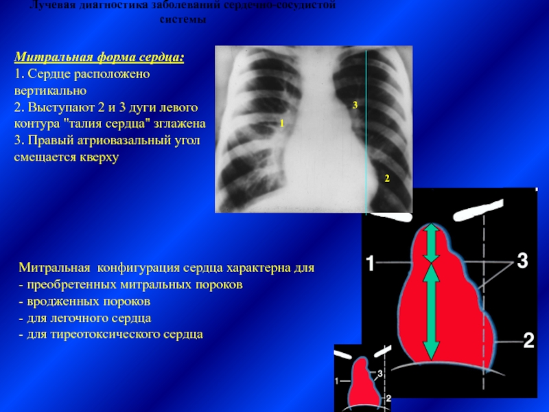 Нормальная конфигурация сердца рисунок