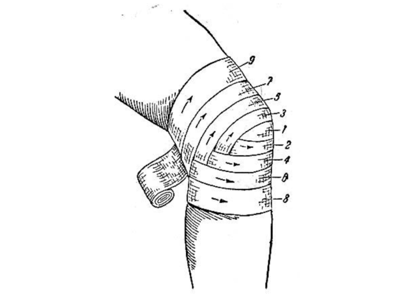 Хирургические повязки техника накладывания картинки
