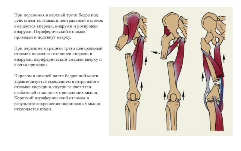 Травмы верхних и нижних конечностей презентация