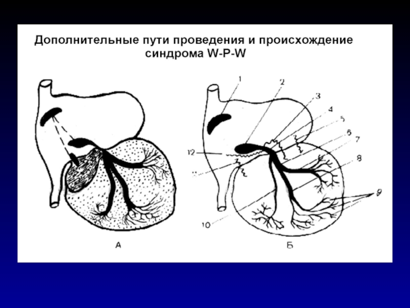 Дополнительный путь. Дополнительные пути проведения. Дополнительные пути проведения в сердце. Добавочные пути проведения сердца. Дополнительные пучки проведения в сердце.