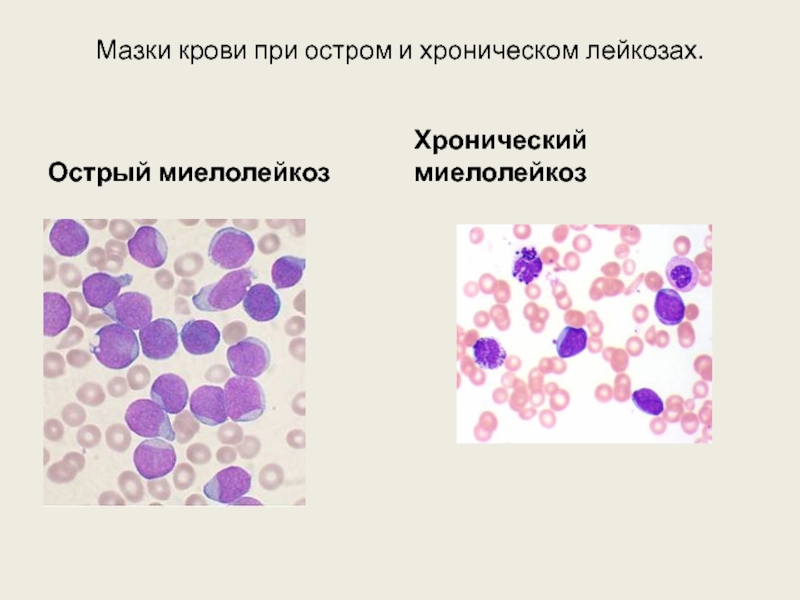 Лейкозы внутренние болезни презентация