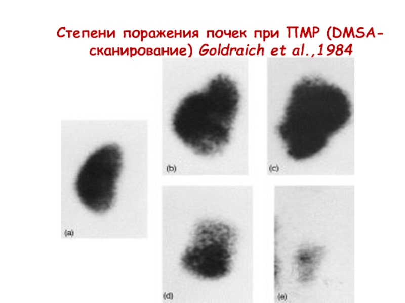 Степень поражения. DMSA сканирование это. Пузырно-мочеточниковый рефлюкс сцинтиграфия. Степень поражения ворсин g 2. Коррекция ПМР при степени.