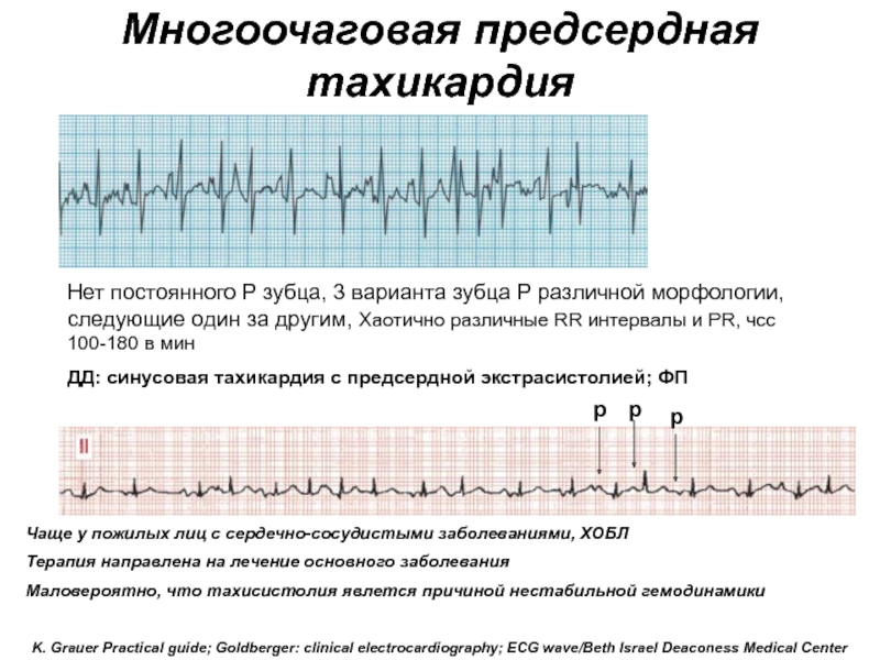 Как лечить тахикардию сердца. Многофокусная предсердная тахикардия на ЭКГ. Предсердная тахикардия на ЭКГ. Предсердная тахикардия на ЭКГ признаки. Предсердная тахикардия на ЭКГ ЧСС.