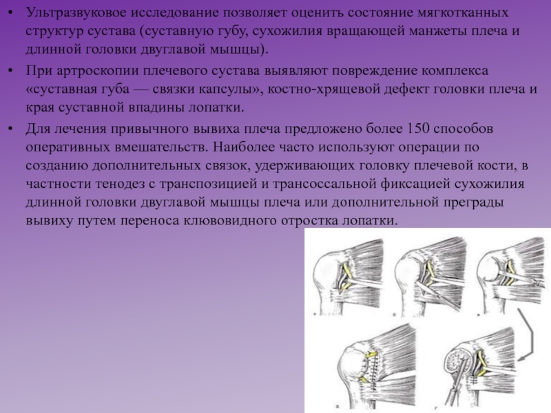 Тендовагинит сухожилия длинной головки двуглавой мышцы плеча